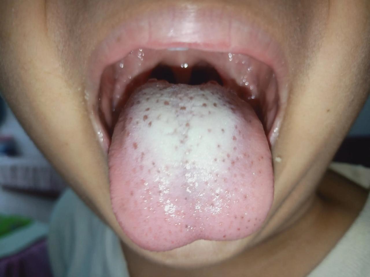 积食是百病之源！积食的3个阶段，你家孩子到达哪个阶段了？
 
▶积食初期
这个阶