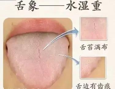 脾虚通常指的是脾气虚，气虚大多数人也会表现为脾气虚。所以治疗的时候气虚之人一般都