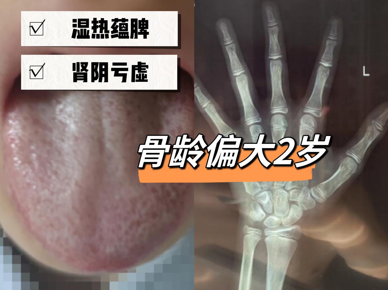 孩子还能长多少，骨龄是不会说谎的！11岁男孩，骨龄13岁，中医干预7个月追高7.