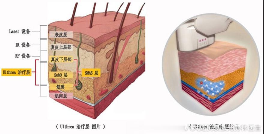 【有黄褐斑可以做超声刀吗？】#微博健康公开课##28天焕颜计划##名医面对面#面