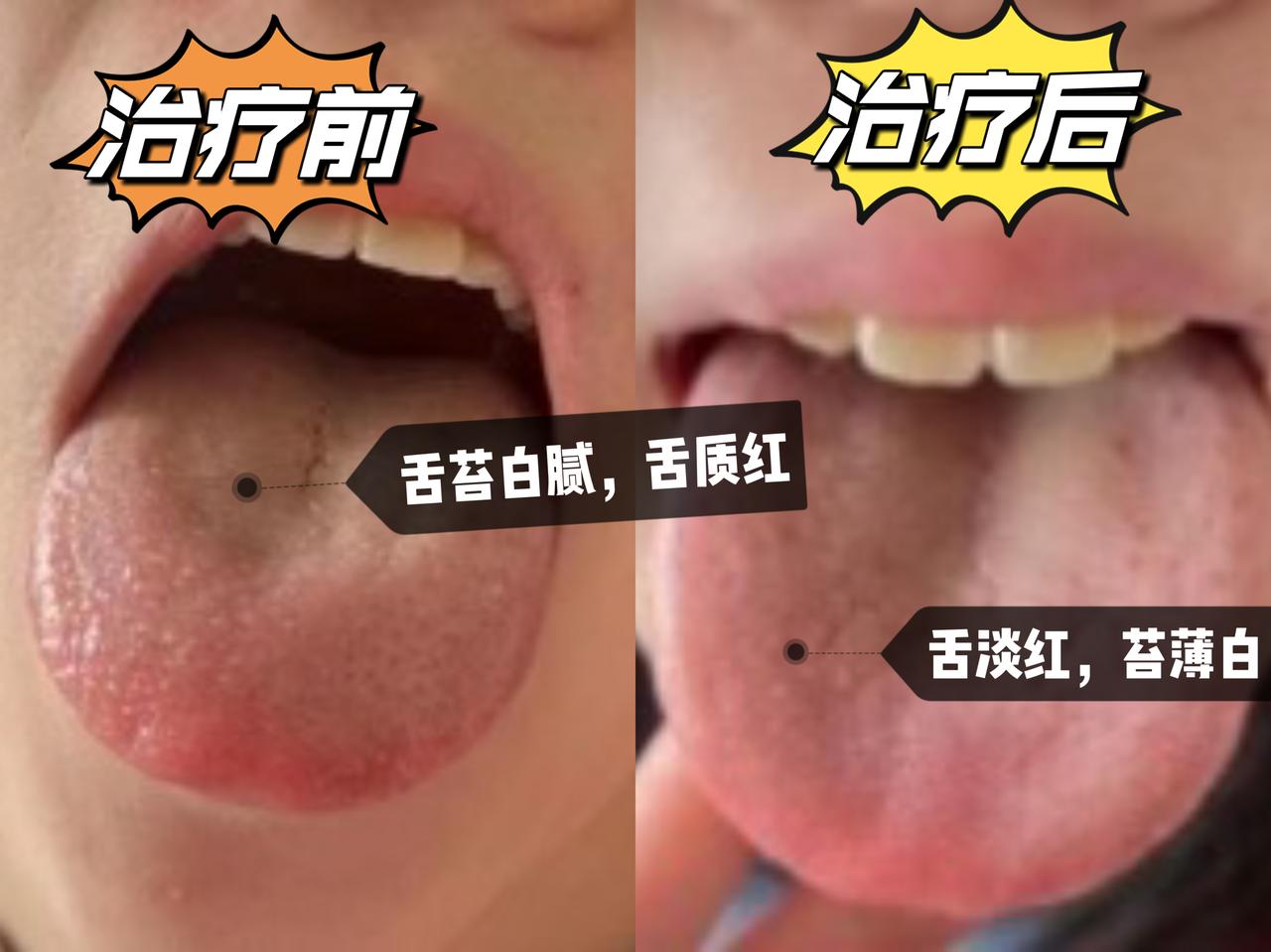 10岁骨龄偏大女孩，中医干预追高两个半月，长高2.5cm！
 
【基本情况】
1