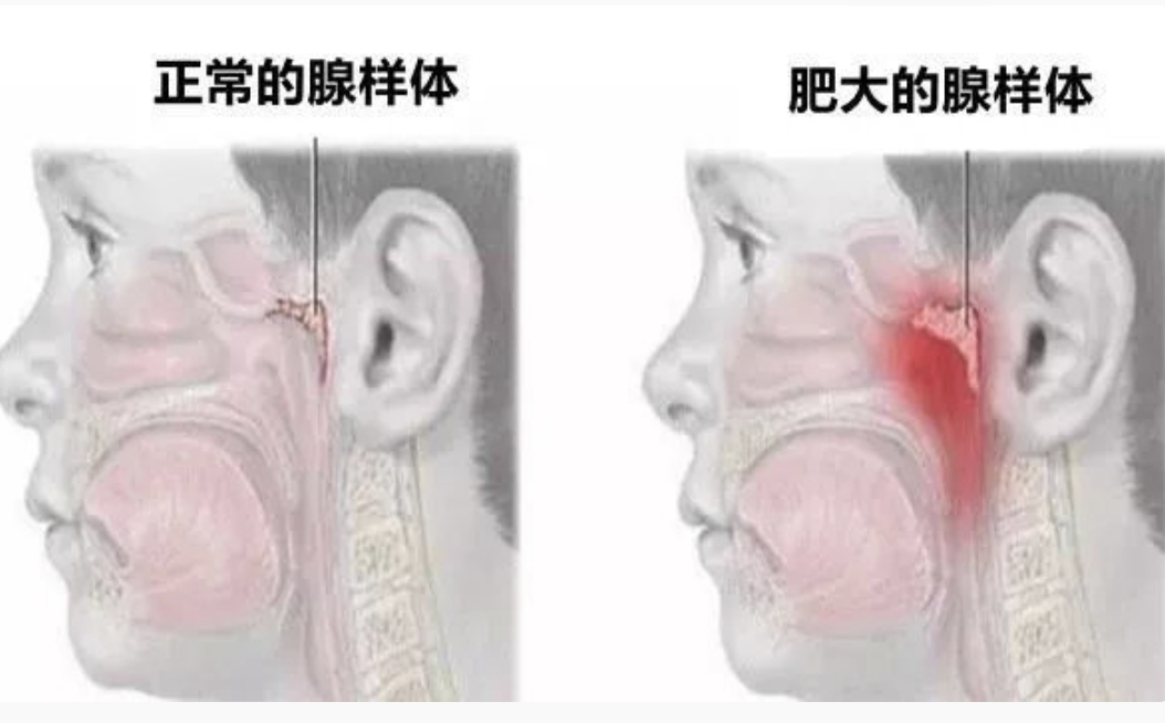  出现口呼吸的情况，需先找到引发原因，才能避免，而不是直接去口腔科。第一种，属于
