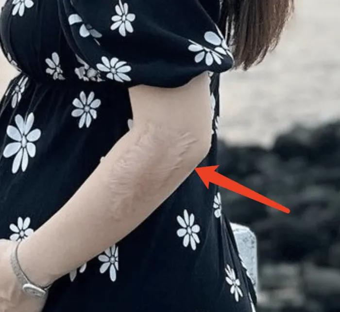 Selina这一身的伤疤看着太恐怖了！
还好拥有乐观的心态，如今怀孕了，也算苦尽