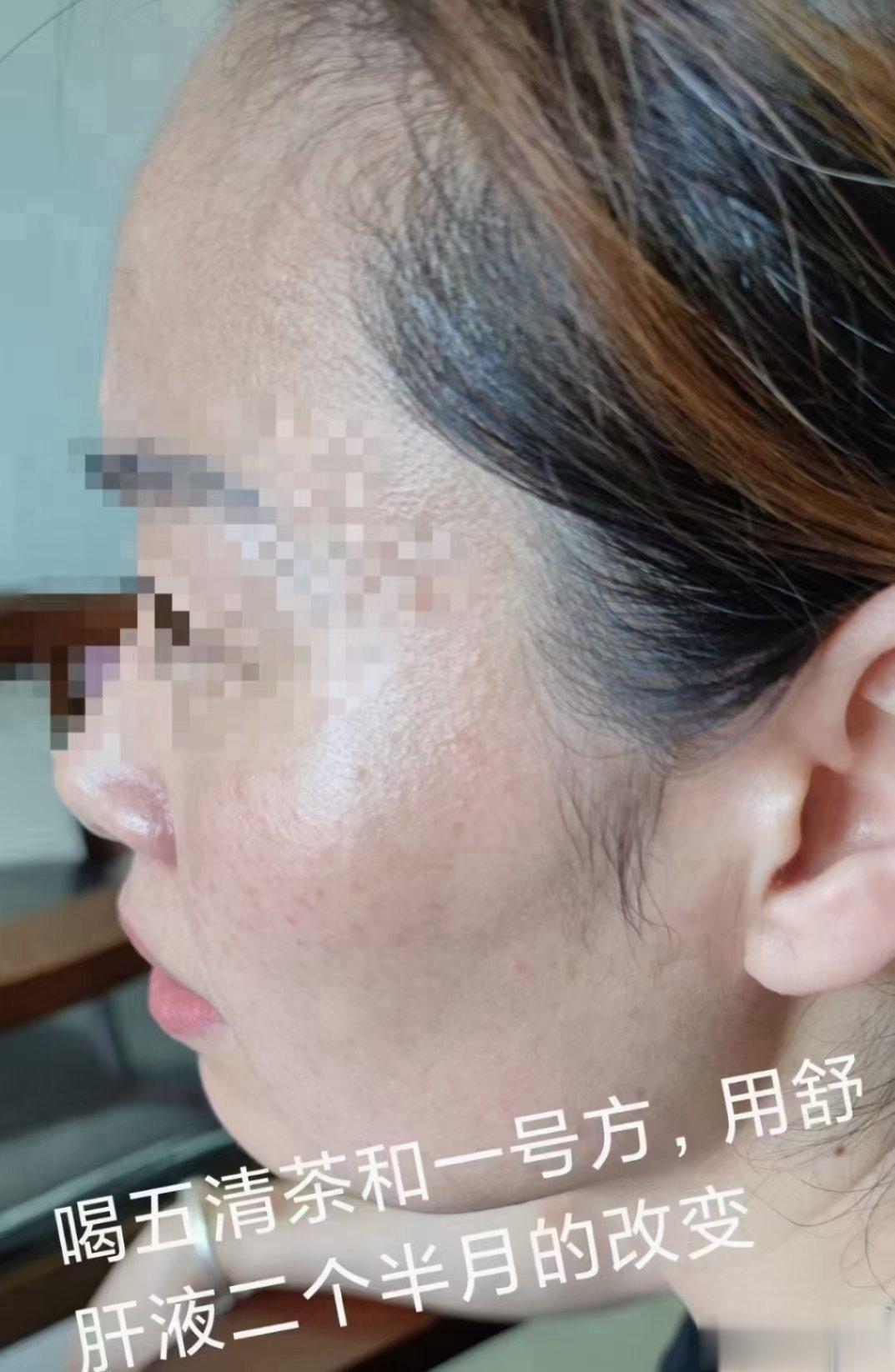  黄金搭档#一号方、五清茶清肺茶 日常打卡来几组面若桃花的调理效果苗家千年一号古