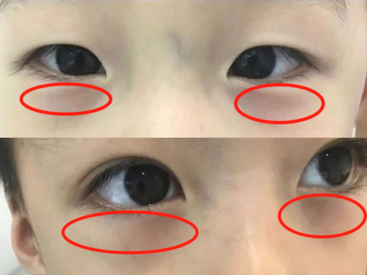 小孩脾胃好不好，看眼袋便知！
 
上眼睑为风池，下眼睑为气池，家长可尝试观察气池