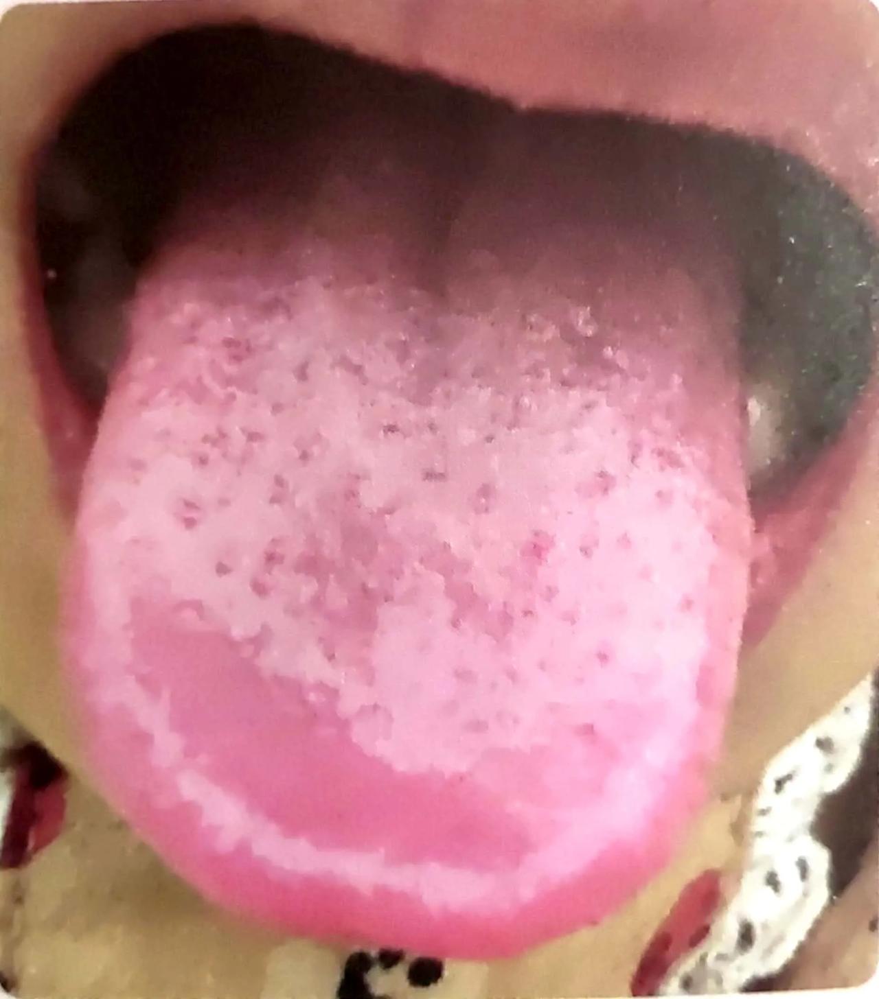 阴虚的孩子会有哪些症状[what]
①大便干燥，脾气不好，好动；
②睡觉时盗汗，