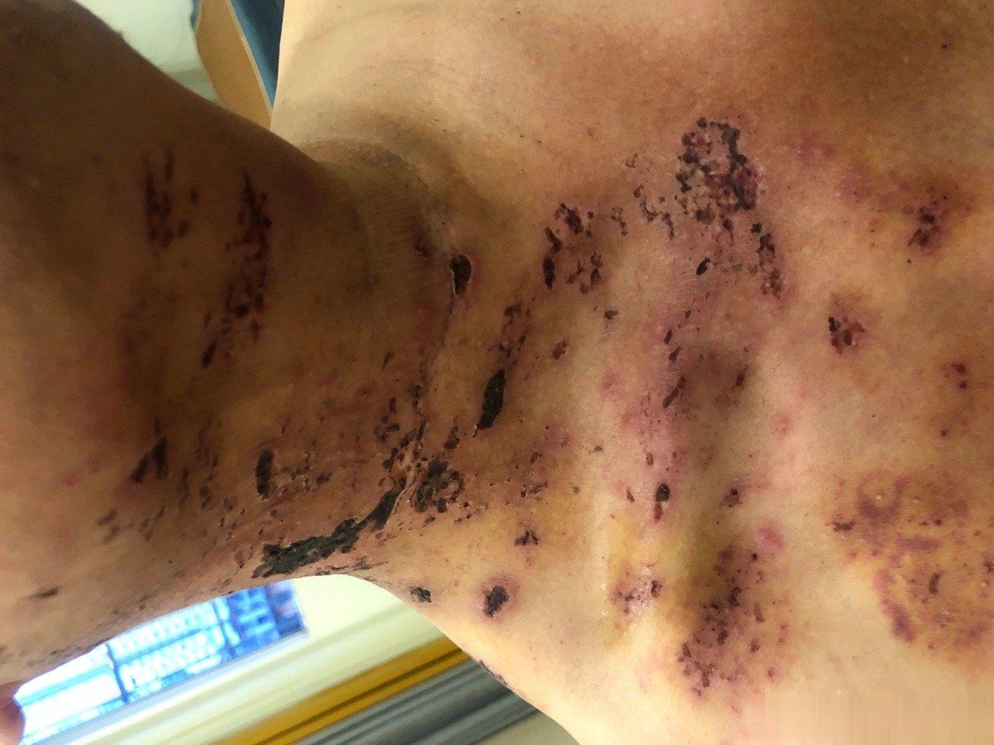 #超90%的成人体内有水痘带状疱疹病毒##微博健康公开课# 带状疱疹应忌口辛辣的