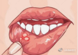 #你是口腔溃疡星人吗##儿童常见病必备手册#【小儿为什么经常口腔溃疡？】口腔溃疡