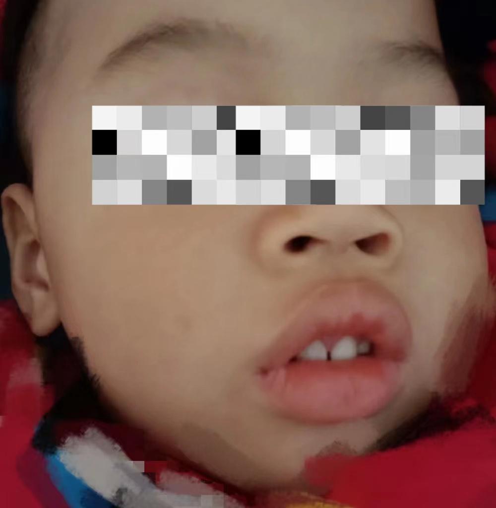 孩子腺样体肥大，早期的几大临床表现，家长们你了解吗？
 
1、腺样体肿大后，会引