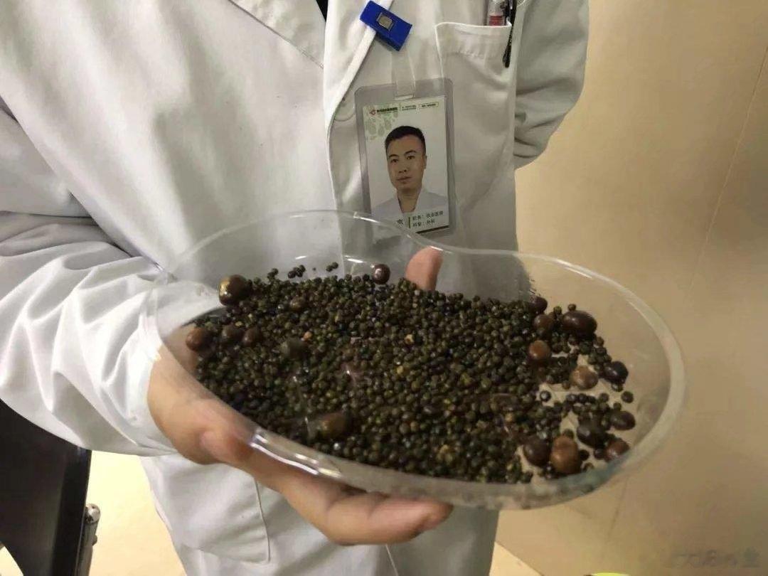 结石病百治百效方——四五六金调散柴胡，白芍，枳壳，炙甘草郁金，金钱草，海金沙，鸡