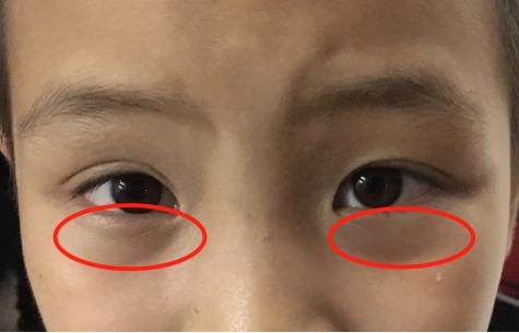 孩子睡眠充足，但仍旧下眼睑发青，黑眼圈重，这是怎么回事？
 
孩子眼窝下眼睑发青