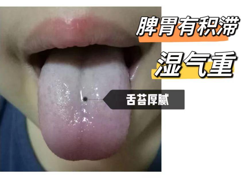 【家长提问】如何判断孩子湿气重不重？
 
解答：判断孩子体内湿气重不重，主要看这
