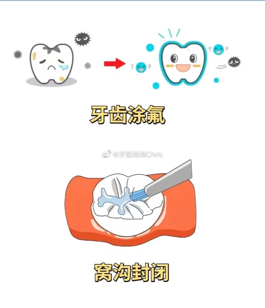 牙齿#窝沟封闭#怎么办👀儿童窝沟封闭，是对儿童进行的一种增强#牙齿#抗龋能力的