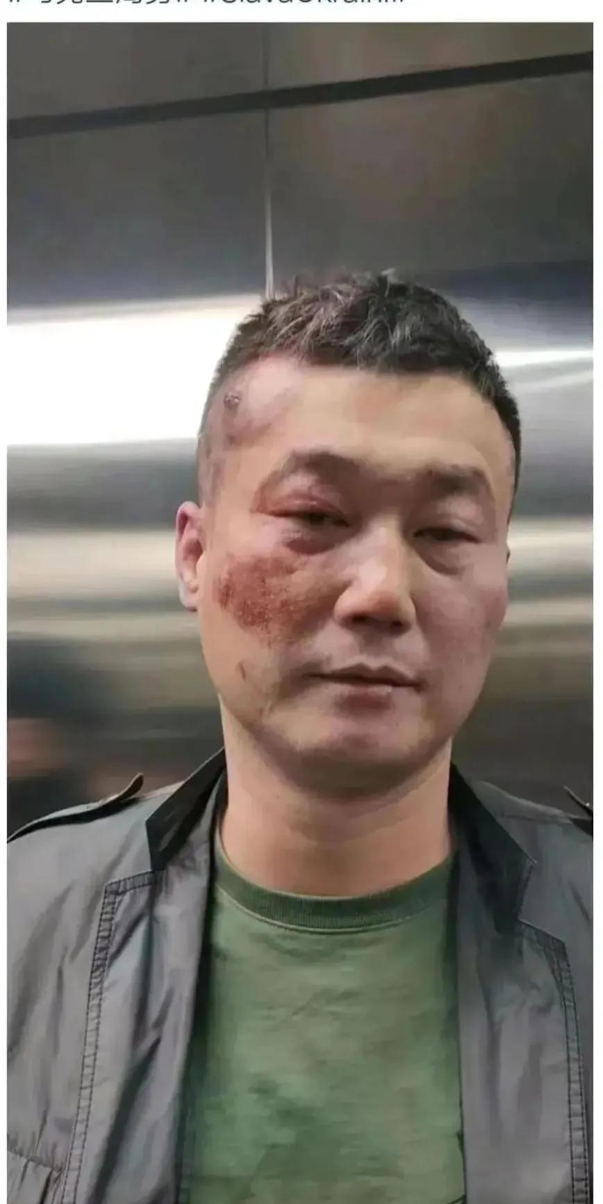 为乌克兰捐款的马聪被打成重伤！

马聪在1月7日通过乌克兰驻华大使馆，给乌克兰捐