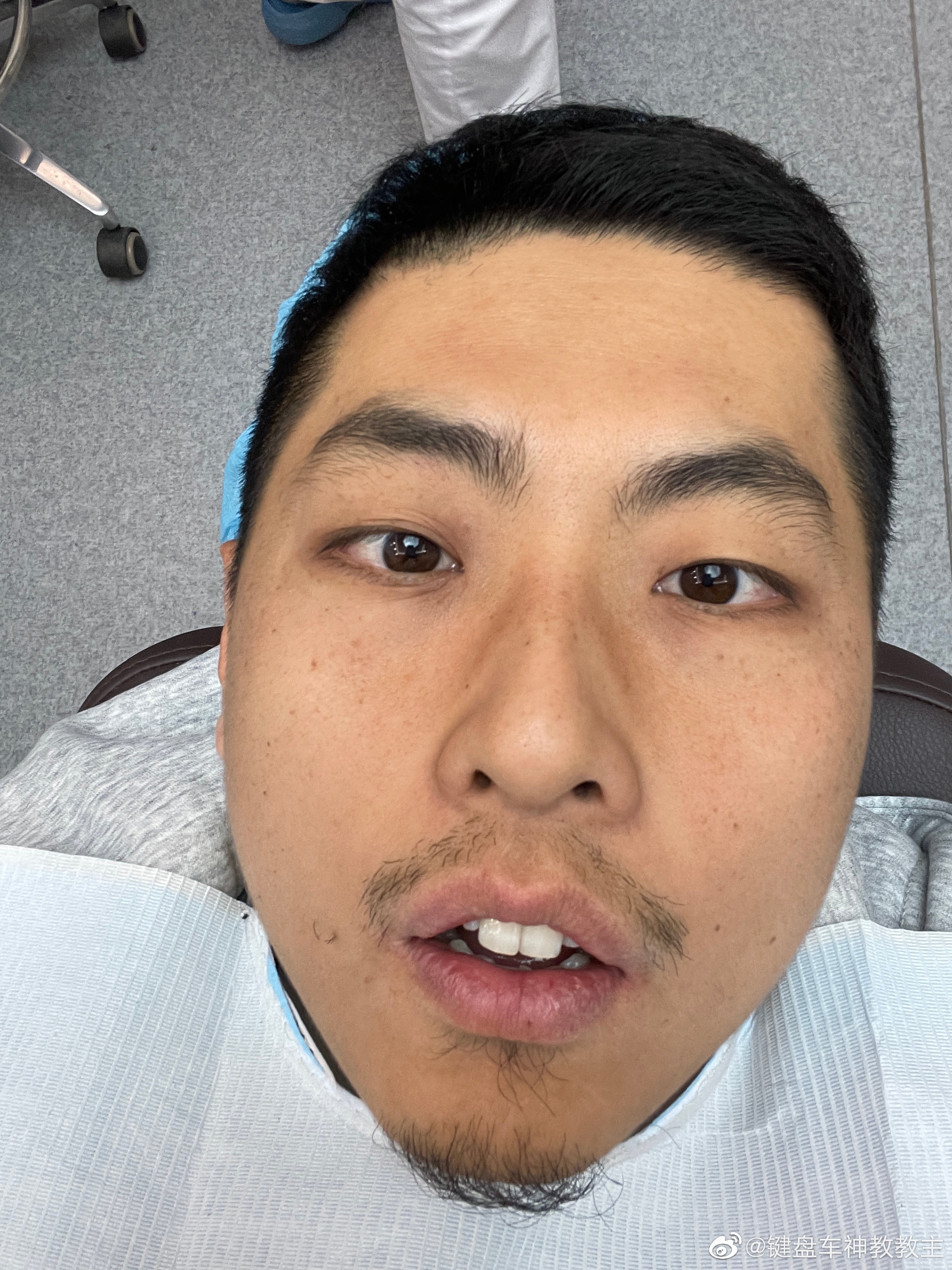 打完麻药了...快死了 ​​​